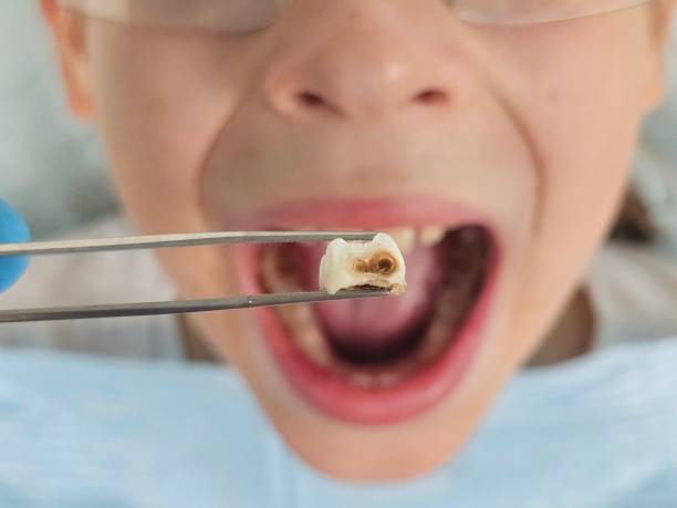 Best Knocked-Out Tooth Emergency  in Golden Beach, MD